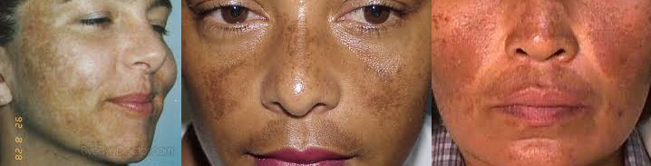 brown spots treatment