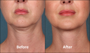 Kybella injectable treatment for double chin available at COsmetique