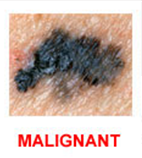 Gotkin,-Melanoma---Image