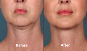 Getting rid of double chin without surgery - Kybella