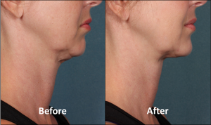 Kybella BeforeAfter2