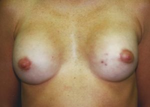 3 After